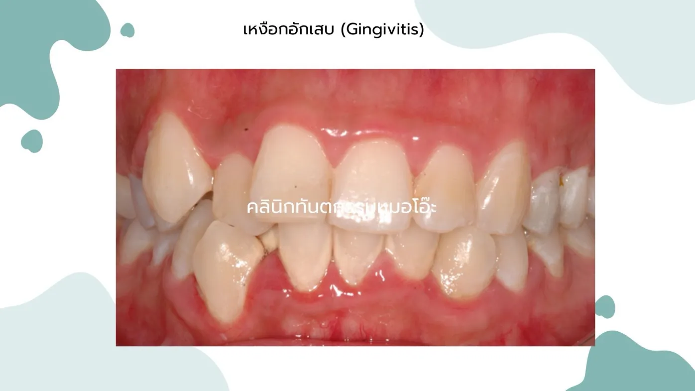 โรคเหงือกอักเสบ (Gingivitis)