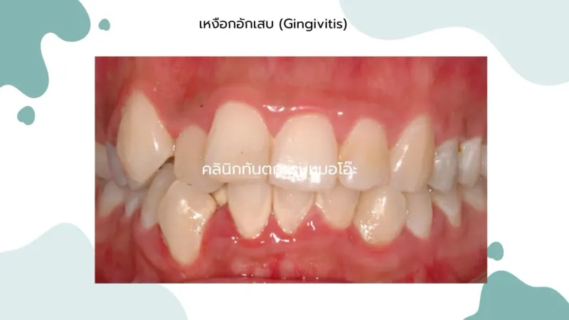 โรคเหงือกอักเสบ (Gingivitis)