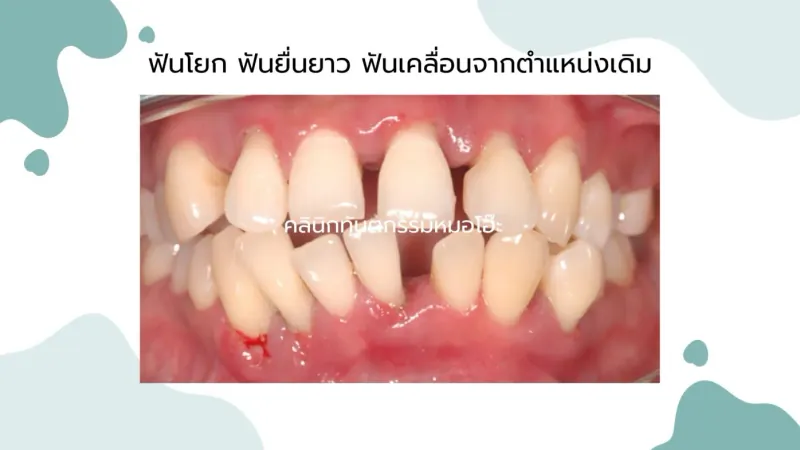 รูปภาพฟันโยก ยื่นยาว ฟันเคลื่อนจากตำแหน่งเดิม