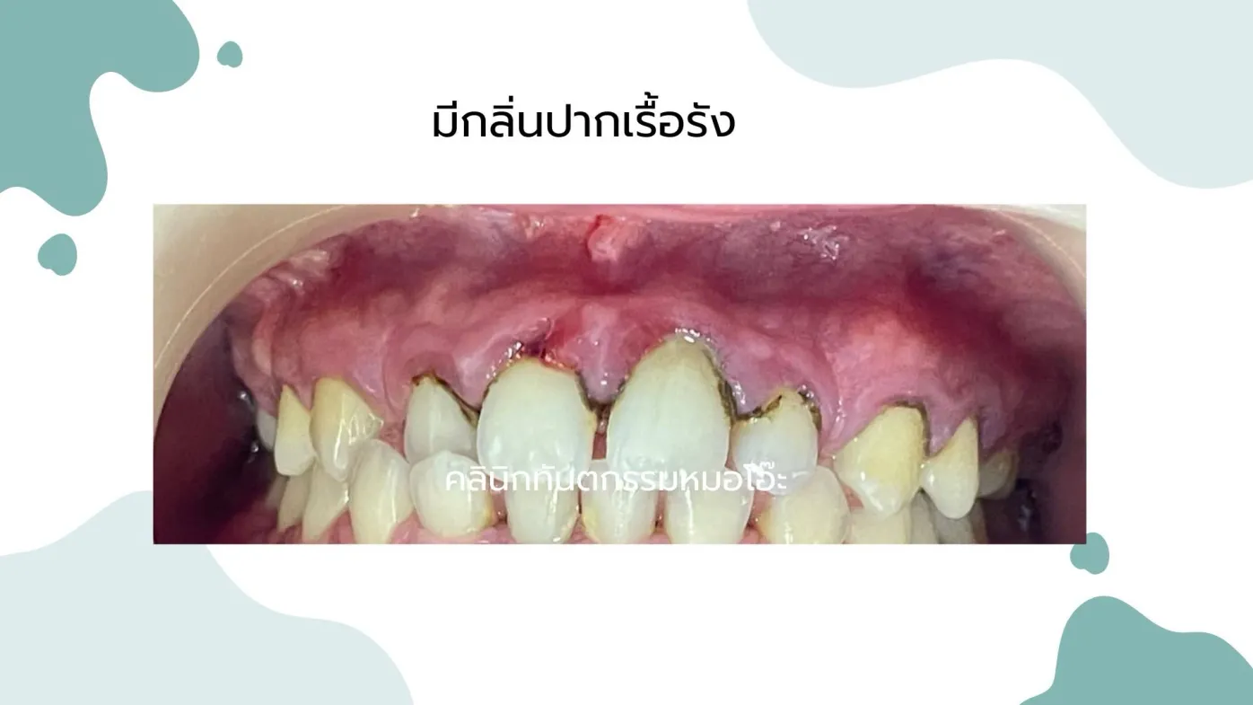 รูปภาพมีกลิ่นปากเรื้อรัง