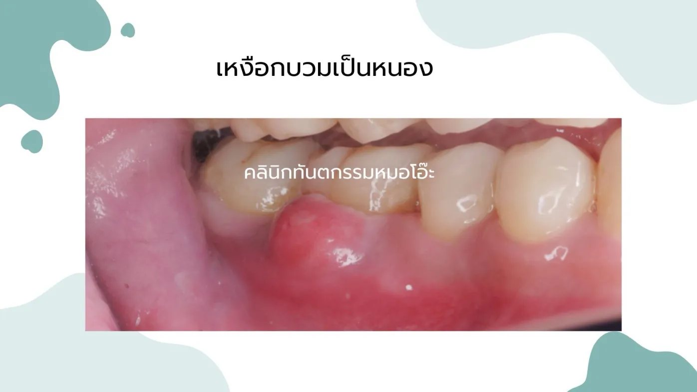รูปภาพเหงือกบวมเป็นหนอง