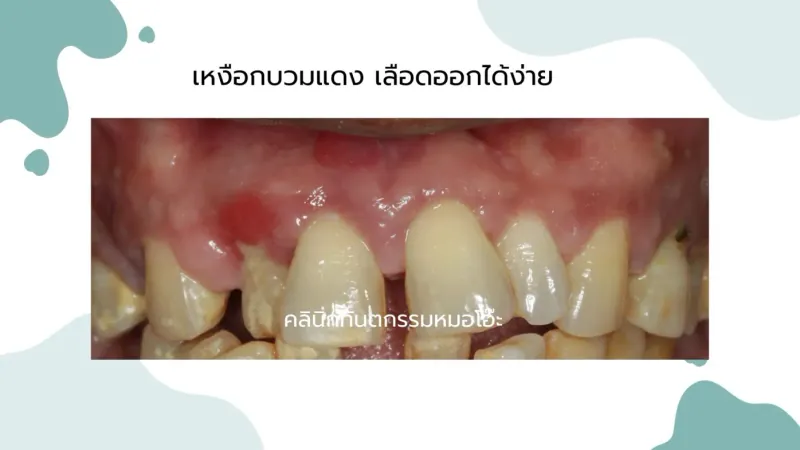 รูปภาพเหงือกบวมแดง (Swollen Gums)