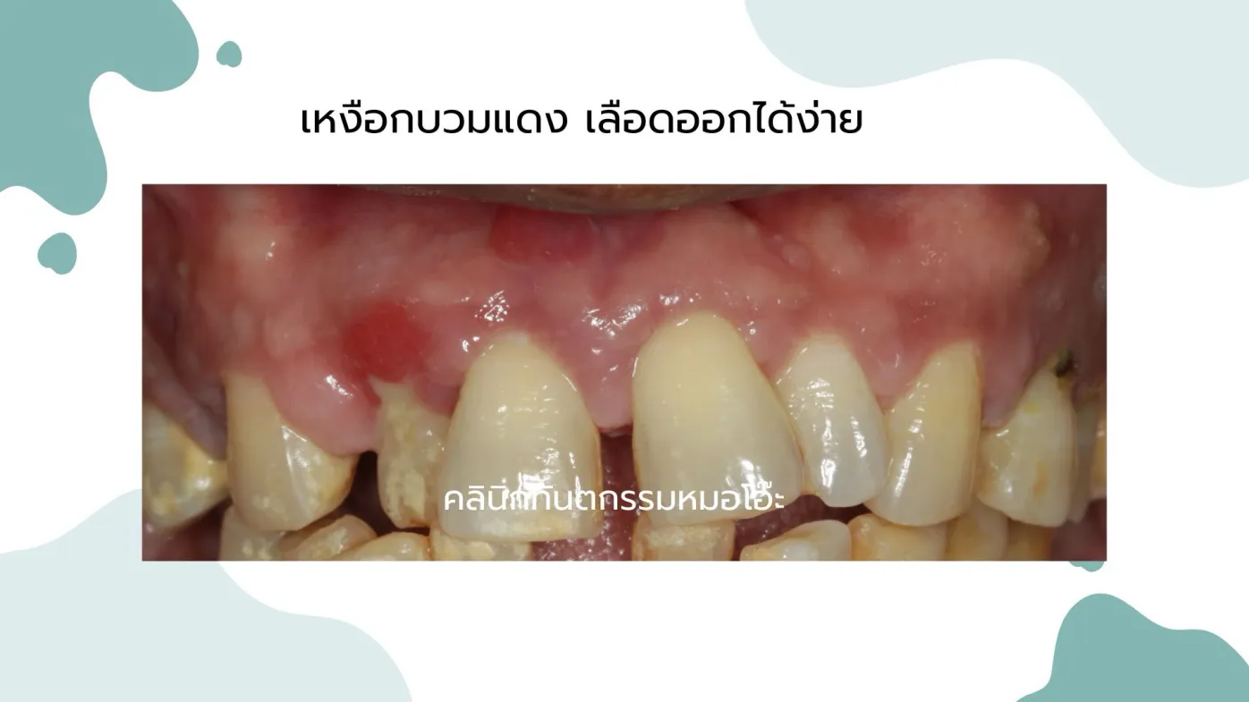 รูปภาพเหงือกบวมแดง (Swollen Gums)