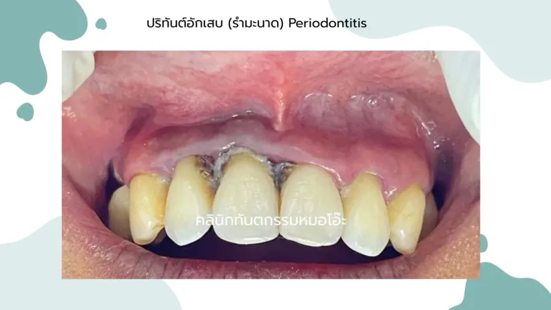 โรคปริทันต์อักเสบ (Periodontitis)