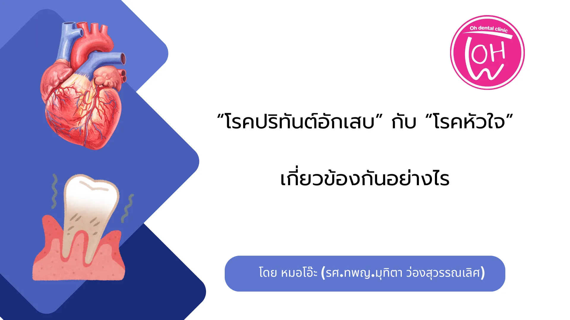 โรคปริทันต์อักเสบ กับโรคหัวใจเกี่ยวข้องกันอย่างไร?