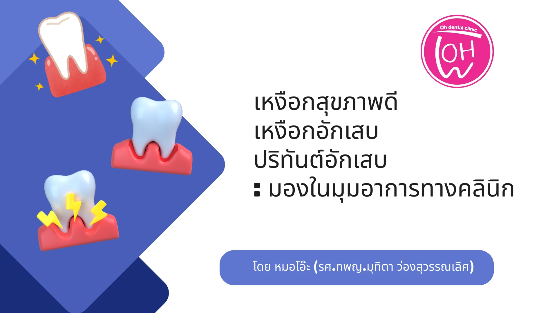 ความแตกต่างของ เหงือกสุขภาพดี เหงือกอักเสบ และปริทันต์อักเสบ : มองในมุมอาการทางคลินิก