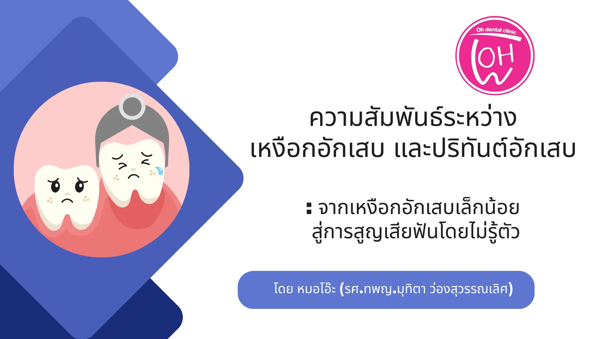 ความสัมพันธ์ระหว่างเหงือกอักเสบและปริทันต์อักเสบ: จากเหงือกอักเสบเล็กน้อย สู่การสูญเสียฟันโดยไม่รู้ตัว
