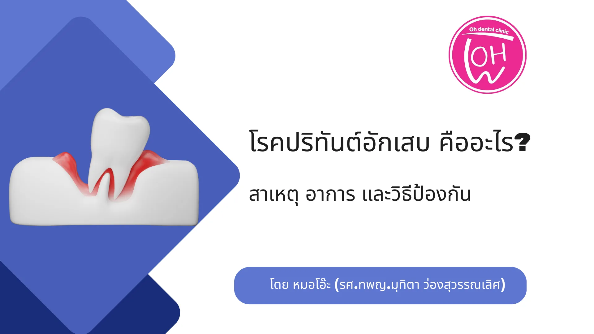 โรคปริทันต์อักเสบ คืออะไร?