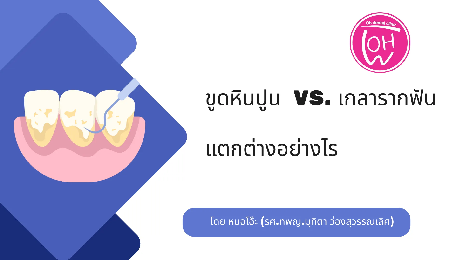 ขูดหินปูน vs. เกลารากฟัน: ความแตกต่างที่สำคัญในการรักษาโรคเหงือก