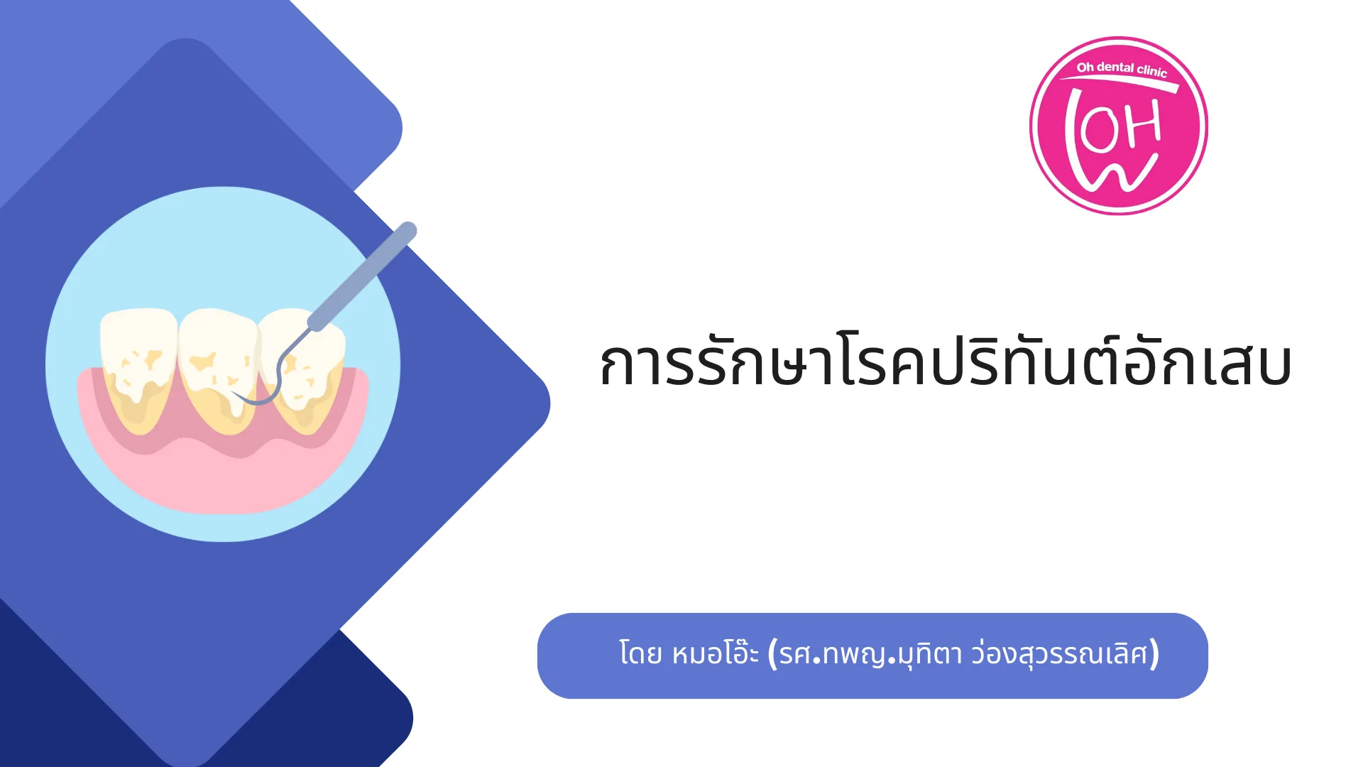  การรักษาโรคปริทันต์อักเสบ คืออะไร?
