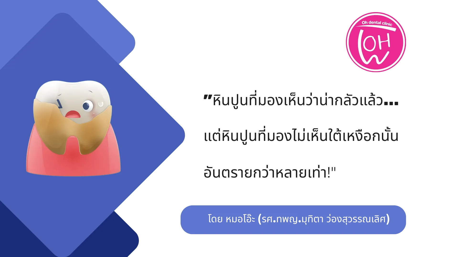 ทำไม "หินปูนใต้เหงือก" ถึงเป็นจุดเริ่มต้นของการสูญเสียฟัน