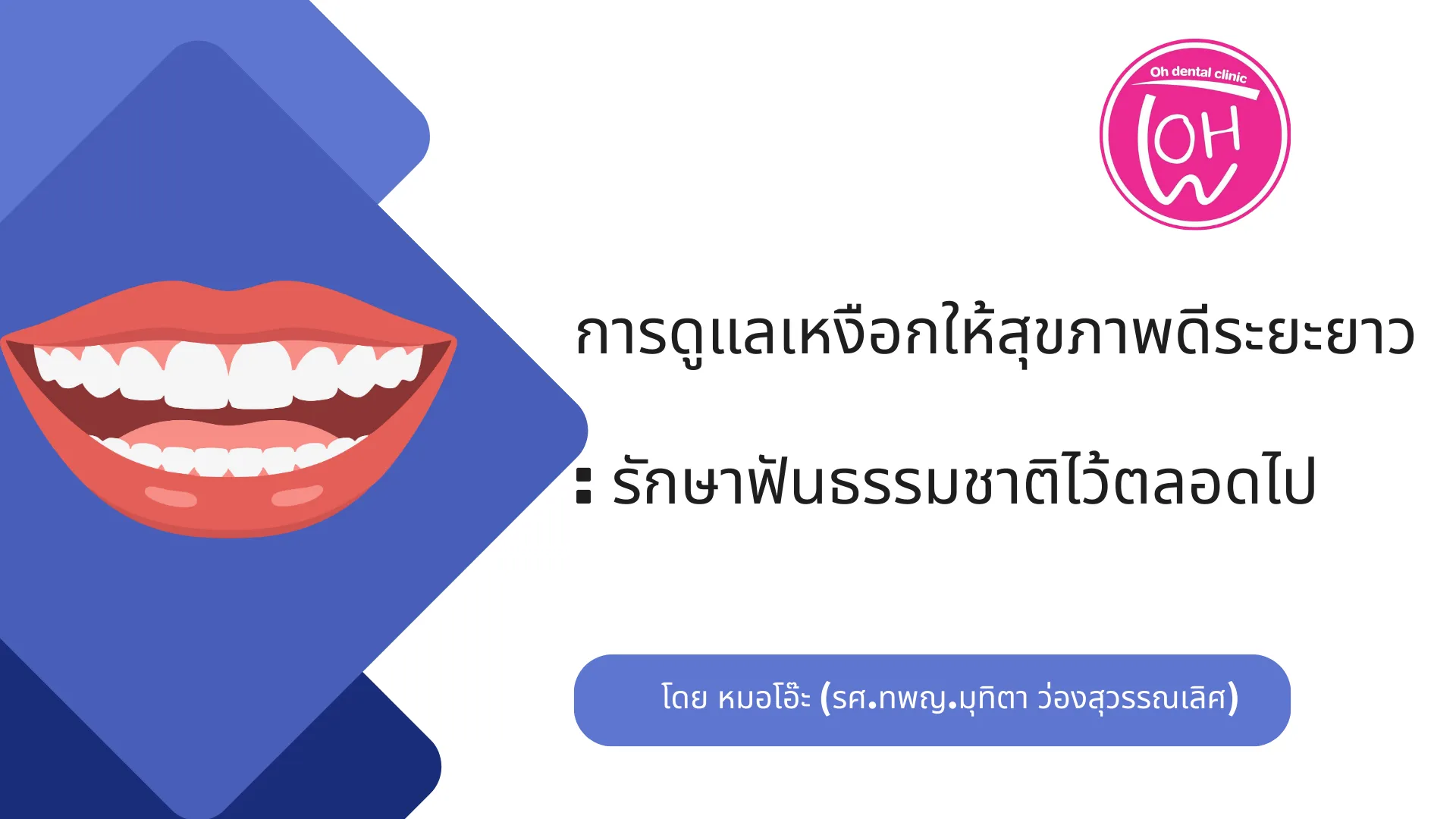 การดูแลเหงือกให้สุขภาพดีระยะยาว: รักษาฟันธรรมชาติไว้ตลอดไป