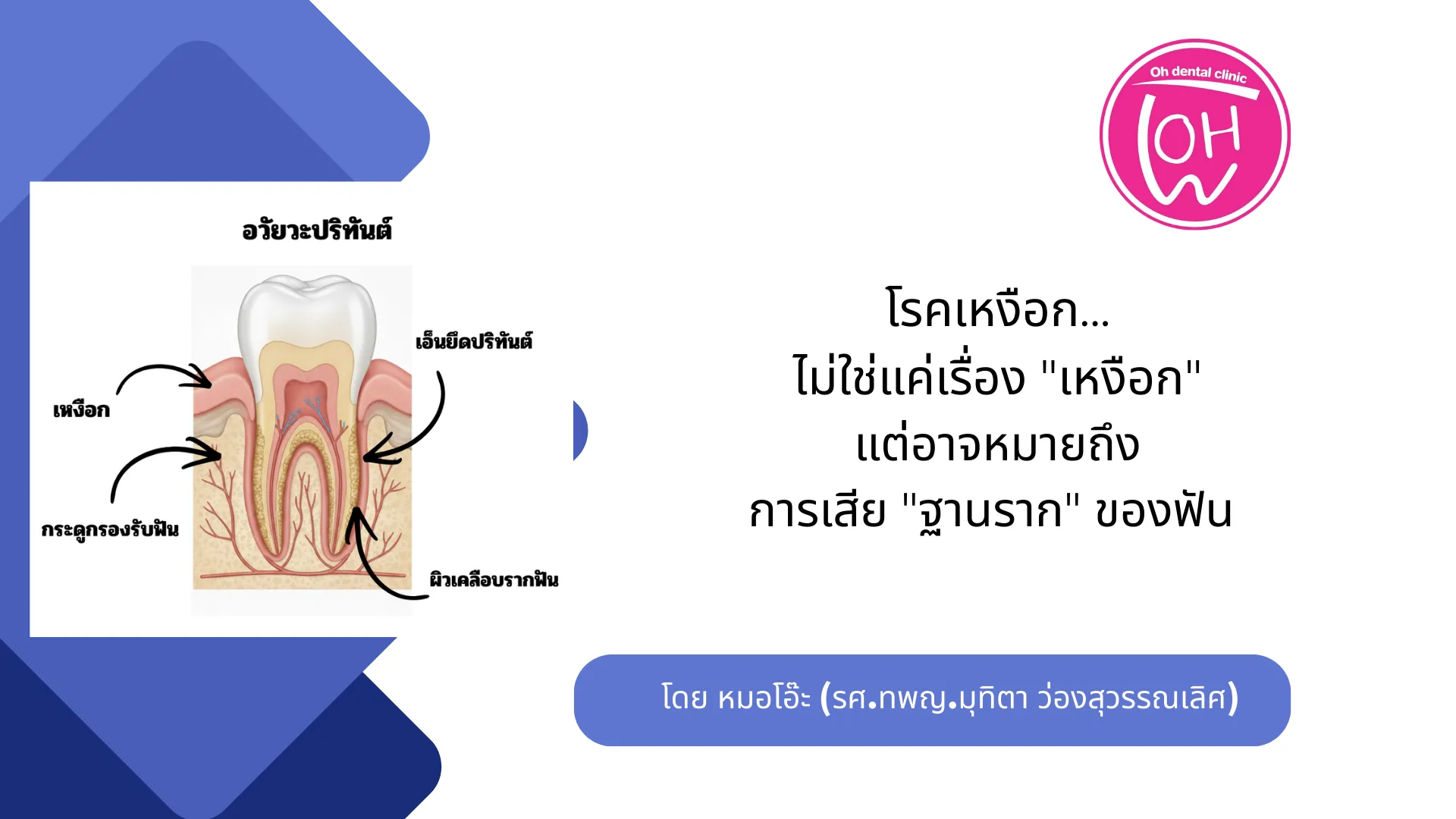 🦷 โรคเหงือก... ไม่ใช่แค่เรื่อง "เหงือก" แต่อาจหมายถึงการเสีย "ฐานราก" ของฟัน
