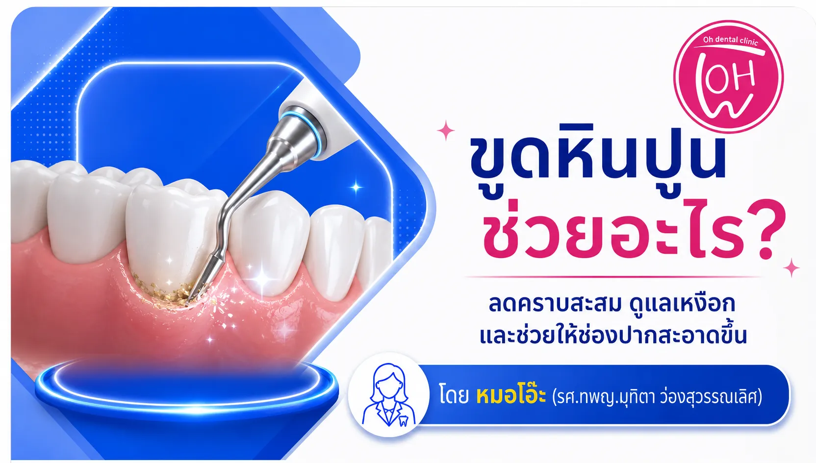 ขูดหินปูนช่วยอะไร