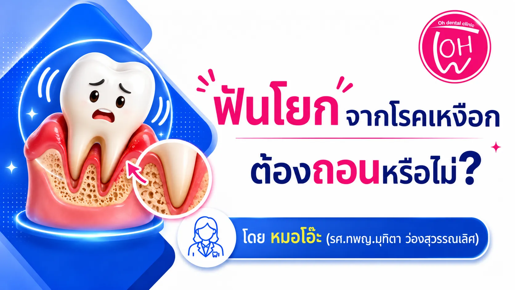 ฟันโยกจากโรคเหงือก ต้องถอนหรือไม่